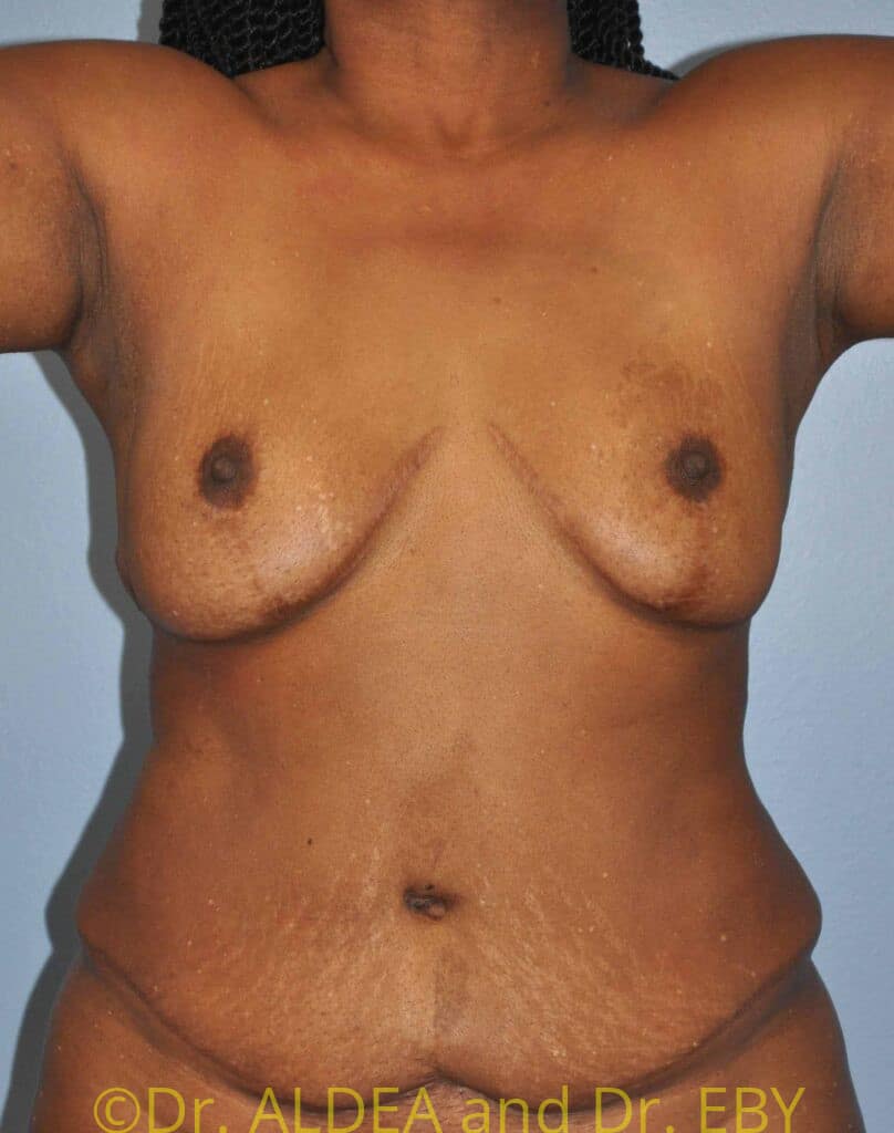 Before Image: Fat Transfer to Breasts #772 - front