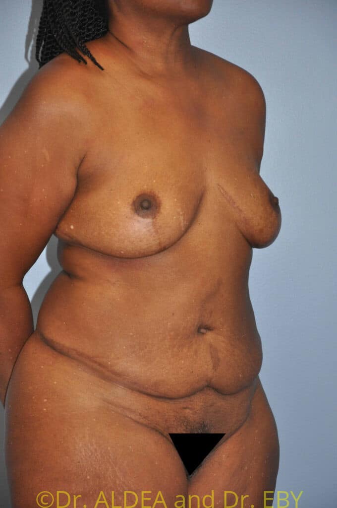 Before Image: Fat Transfer to Breasts #772 - right-front-oblique