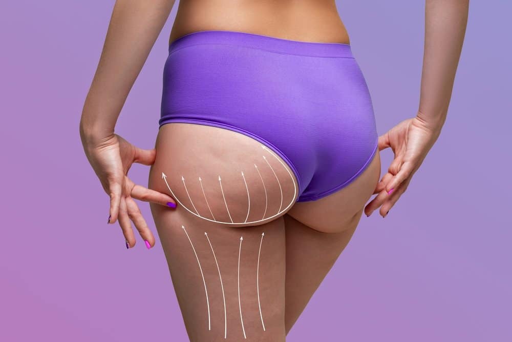 Close up of a woman's butt with grid marks to show how a BBL can shape it. Close up of a woman's butt with grid marks to show how a BBL can shape it.