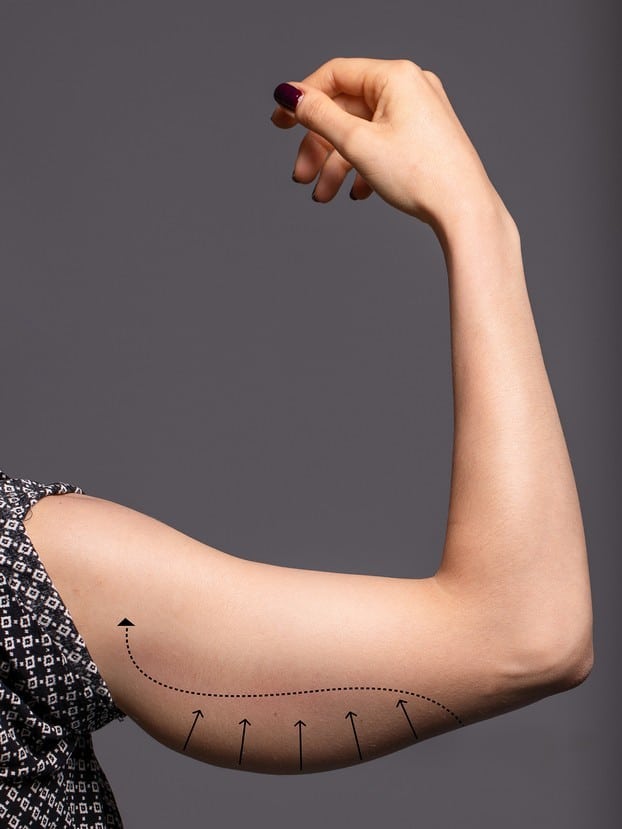 Close up of a patient's arm with excess skin hanging, in need of a post-weight loss arm lift.